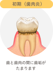 初期（歯肉炎）　歯と歯肉の間に歯垢がたまります