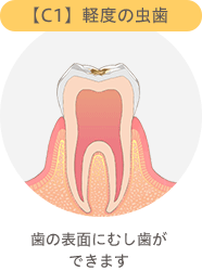 【C1】軽度の虫歯　歯の表面にむし歯ができます
