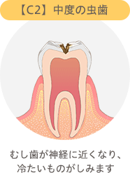 【C2】中度の虫歯　むし歯が神経に近くなり、冷たいものがしみます