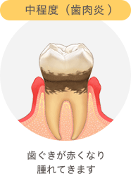 中程度（歯肉炎）　歯ぐきが赤くなり腫れてきます